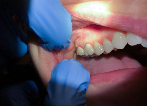 Best Emergency Dental Care for Broken or Chipped Teeth in Tlassee, AL